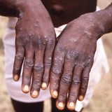 Ein Mann aus Kongo zeigt seine mit Affenpocken (Mpox) übersäten Hände.