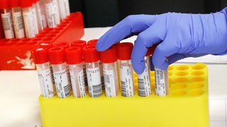 Im Labor eines Krankenhauses wird eine PCR-Test auf das Coronavirus untersucht.