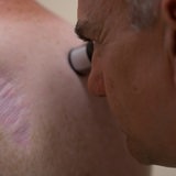 Ein Arzt überprüft ein Muttermal auf einem Rücken.