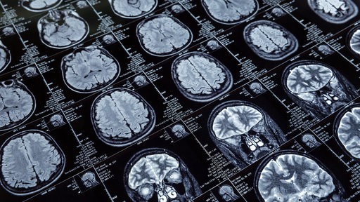 Magnetresonanz-Aufnahme eines Alzheimer geschädigten Gehirns