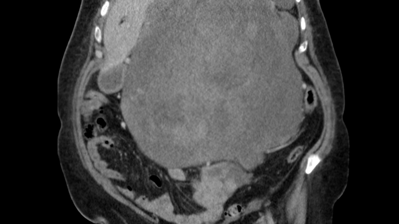 Eine CT-Aufnahme eines 8,5-Kilogramm-schwerem Tumors, der im Bauchraum einer Patientin sitzt.